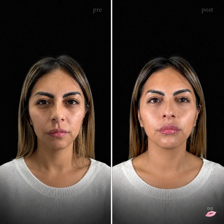 Face contouring prima e dopo - armonizzazione ovale del viso vista frontale - Dr. Lips Milano