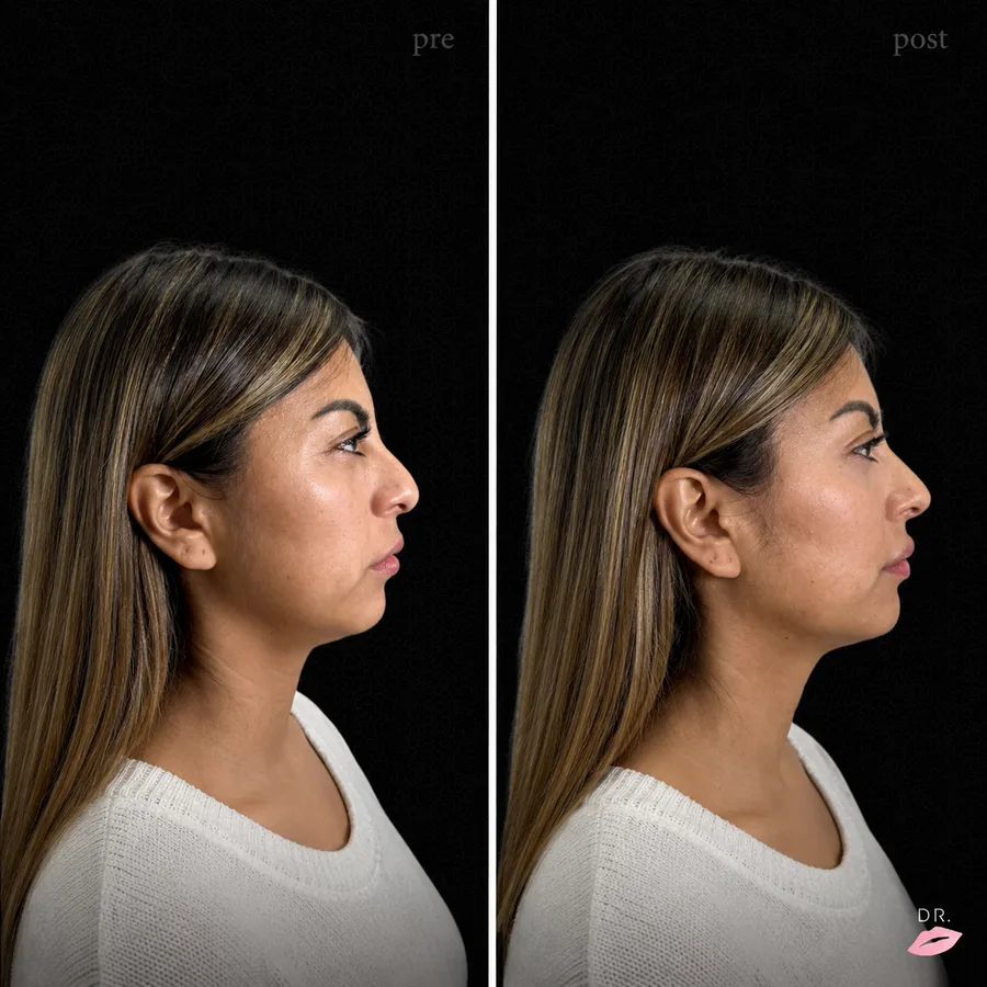 Face contouring prima e dopo - profilo, rimodellamento zigomi e mandibola - Dr. Lips