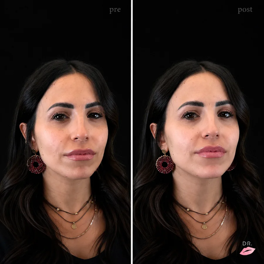 Face contouring prima e dopo - definizione dei lineamenti del viso - Dr. Lips