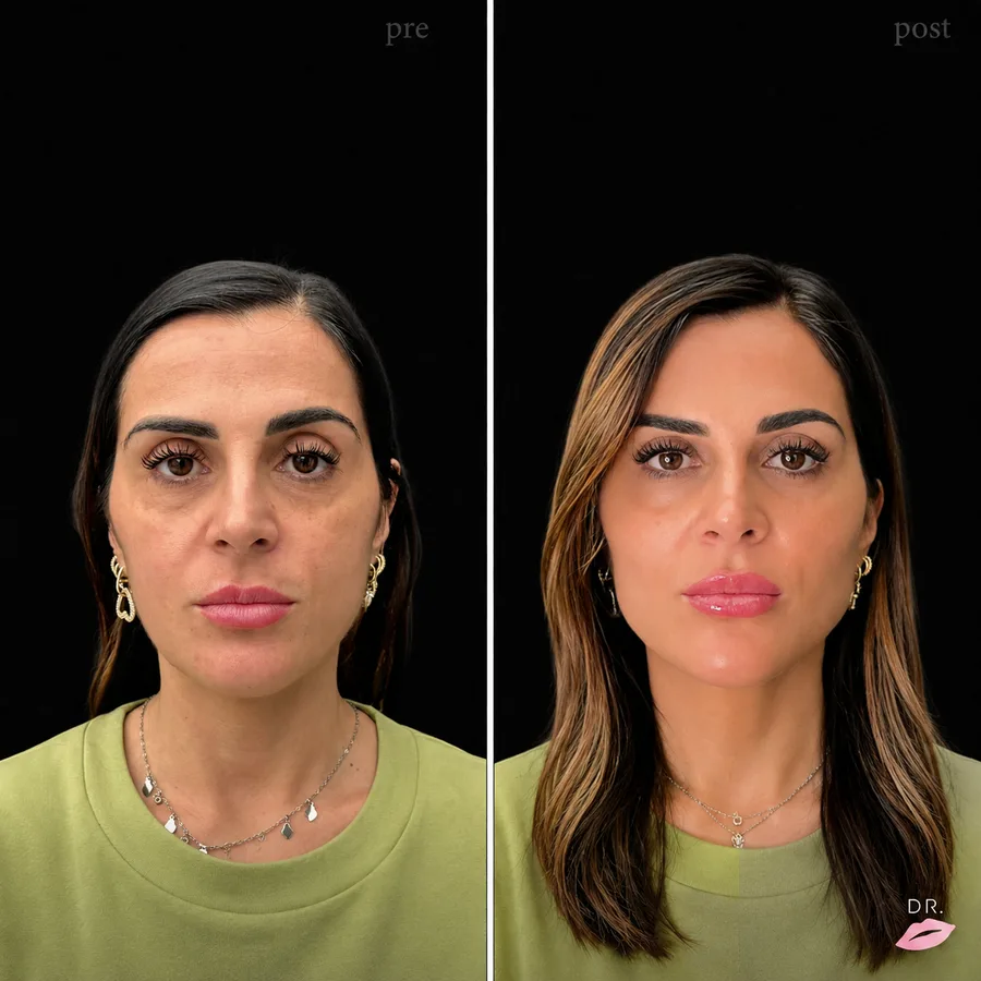 Face contouring prima e dopo - risultato naturale full face - Dr. Lips