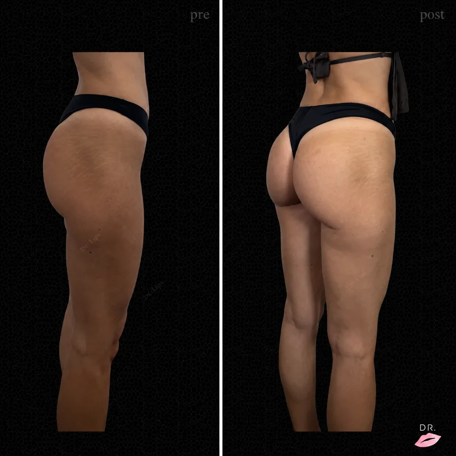 Filler glutei prima e dopo - profilo destro, volumizzazione con acido ialuronico - Dr. Lips