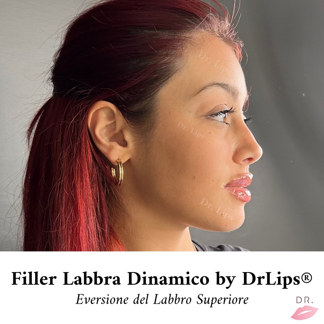 filler labbra drlips