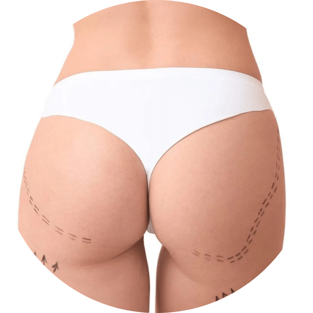 filler glutei