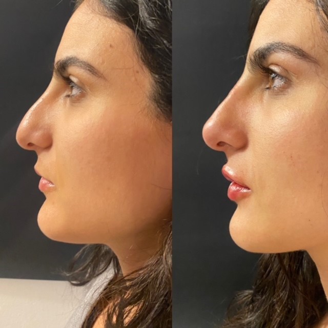 rinofiller dr lips risultati